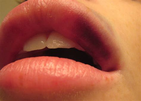Lip Bruise Help Beautylish