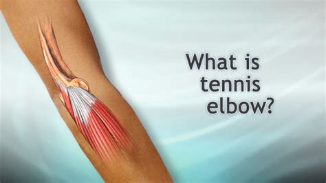 Hie Multimedia Tennis Elbow Surgery