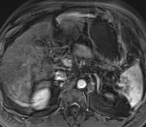 Axial T1 Weighted Fat Suppressed Post Contrast Mri Image In The