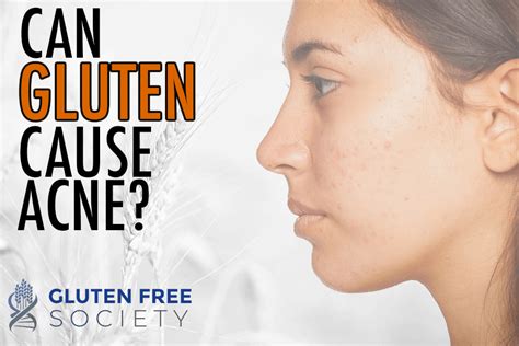 Can Gluten Cause Acne Richard Howell Blog