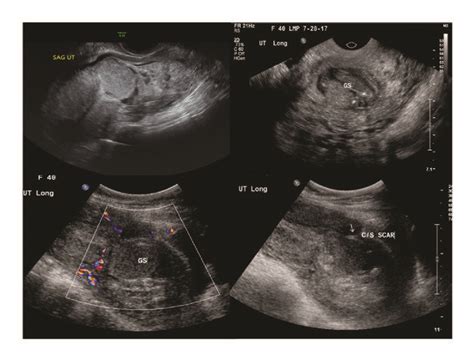 Sonographic Findings When Patient Presented To The Emergency Room