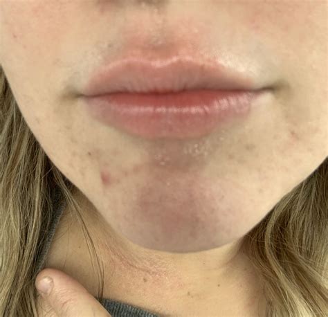 Can You Get Contact Dermatitis On Your Lips