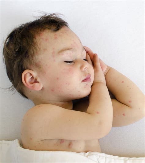 Mosquito Bite On Baby
