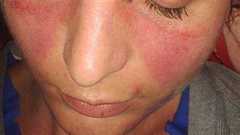 Preventive Medicine How To Fix Dry Skin Rash On Face