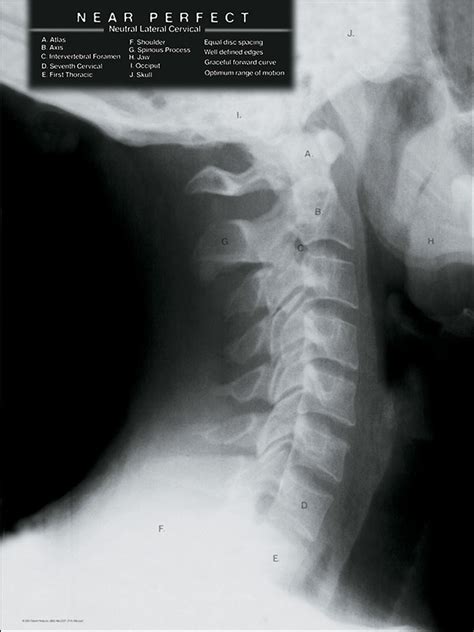 Normal Neck X Ray Textbook Cervical Spine X Ray Poster