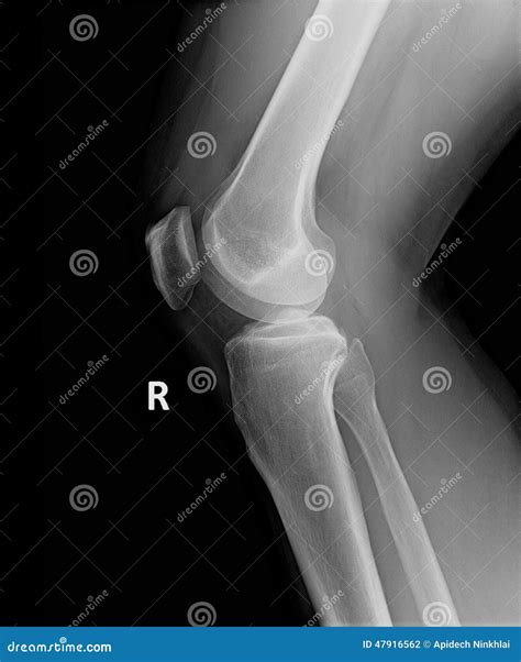 X Ray Image Of Perfect Knee And Leg Stock Photo Image Of Emit Light