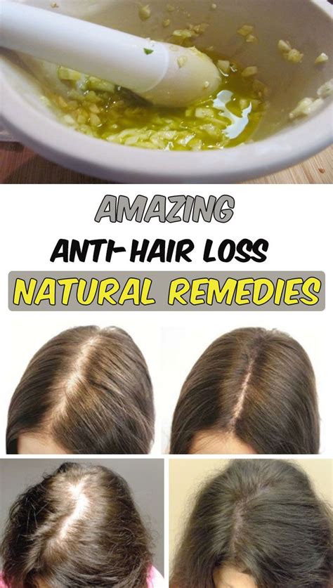 8 Amazing Anti Hair Loss Natural Remedies With Images Hair Loss Natural Remedy Anti Hair