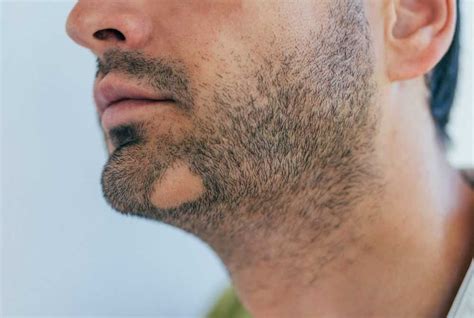 Bald Spot In Beard Under Chin Treatment Proven Methods Beardcontent