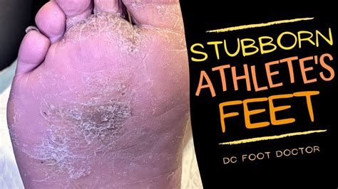 Stubborn Athletes Feet Tinea Pedis Treatment Fungal Skin Infection