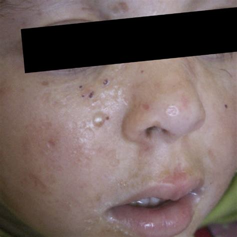Diffuse Waxy Thickening Of The Skin On The Face With Multiple Vesicles