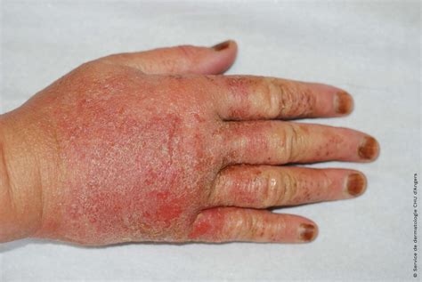 Top 115 Imagenes De Dermatitis En Las Manos Theplanetcomicsmx