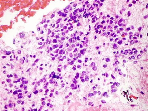 Fig 813 Small Cell Carcinoma University Of Wisconsinmadison