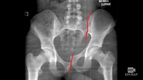 Pelvic X Ray Anatomy Anatomical Charts Posters