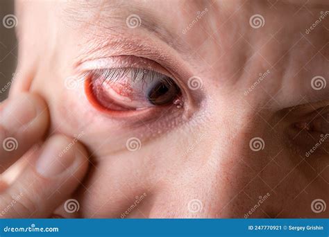 Subconjunctival Hemorrhage Hyposphagma Close Up Of Man S Face