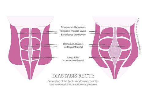 Female Body Pregnancy Normal Muscles Diastasis Recti Pregnancy Body