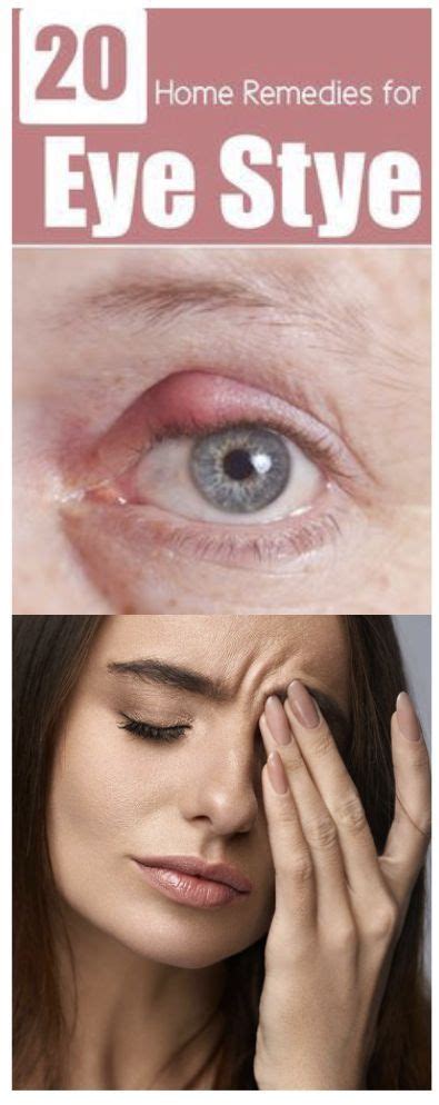 26 Effective Home Remedies For Eye Stye Checkthis Remedies Eye