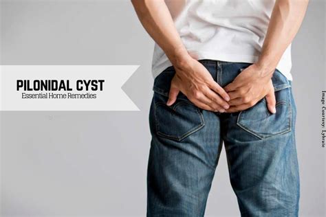 Pilonidal Cyst Heres A Soothing Cure To This Painful Problem