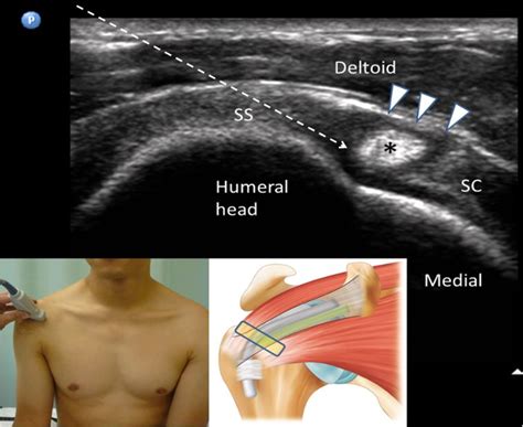 How I Do It Ultrasound Guided Injection For The Shoulder Part 2
