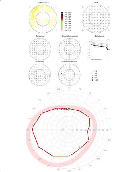 Patient 1 With Normal Central Visual Field And A Depressed Isopter