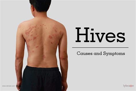 Hives Causes And Symptoms By Dr Rasya Dixit Lybrate