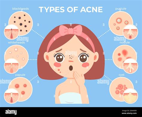 Girl With Acne Young Unhappy Female Face With Skin Problems And Pimple
