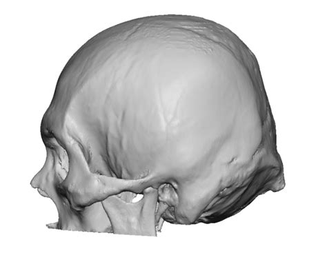 Plastic Surgery Case Study Lengthening The Brachycephalic Head Shape