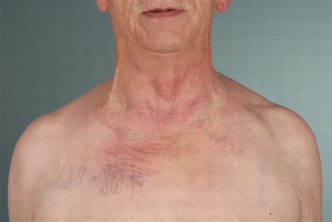 A Man With Dilated Veins On His Upper Chest The Bmj