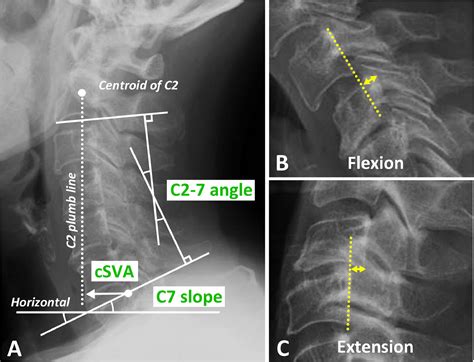 Segmental Cervical Instability Does Not Drive The Loss Of Cervical