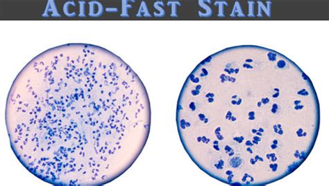 Acid Fast Staining Or Ziehl Neelsen Staining Principle Requirements Procedure And