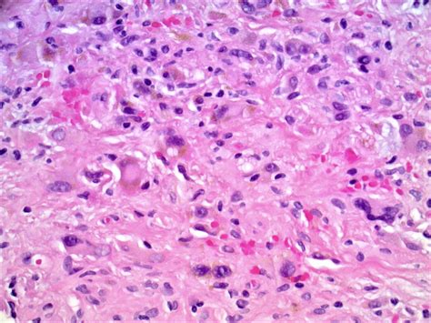Pathology Outlines Angiofibroma Fibrous Papule