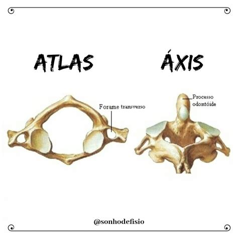 Articulacion Atlas Axis