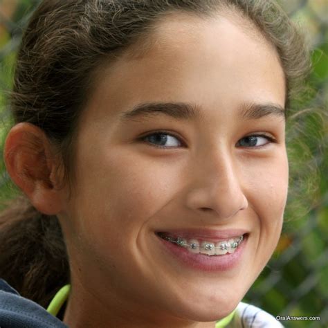 60 Photos Of Teenagers With Braces Oral Answers