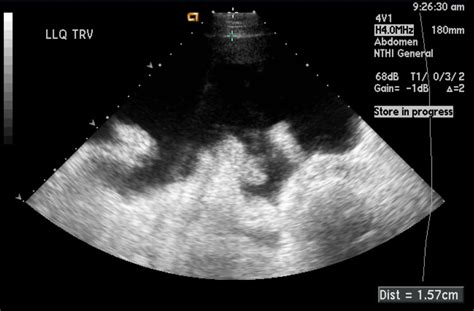 Ascites Ultrasound Wikidoc