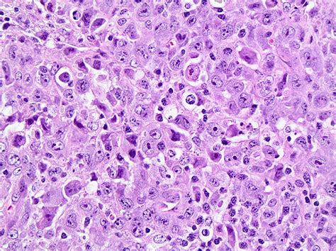 Angioimmunoblastic T Cell Lymphoma Pathology Outlines Histopathology