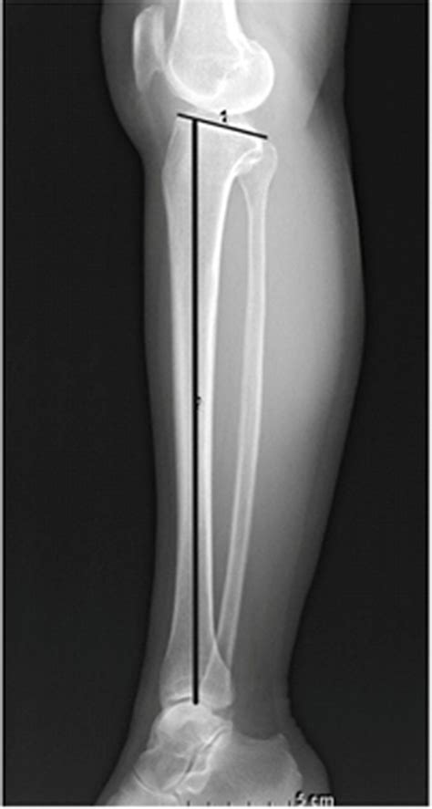 Measurement Of The Posterior Tibial Slope Defined As The Angle Between