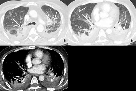 Figure 1 From A Case Of Diffuse Hepatic Hemangiomatosis Coexistent With