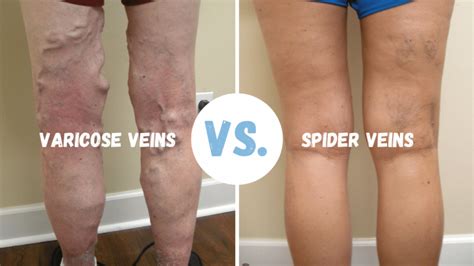 Understanding Vein Disease Its More Than Skin Deep