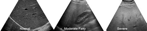 Hepatic Steatosis Fatty Liver Sonographic Tendencies