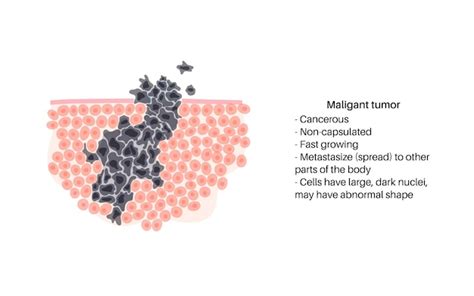 Premium Vector Vector Isolated Illustration Of Malignant Tumor In