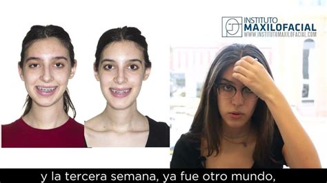 Transforma Tu Rostro Con Xito Asimetr A Facial Antes Y Despu S Los