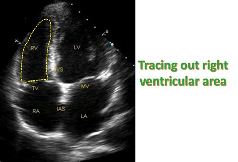 Right Ventricular Function By Echocardiography All About