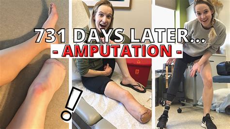 2 Years An Amputee Revisiting My Amputation Decision Youtube