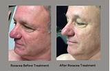 Rosacea Treatment Topical Medications Pictures