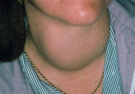 Swelling Of Neck Due To Thyrotoxic Goitre Photograph By Science Photo
