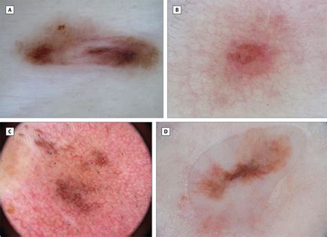 Recurrent Melanocytic Nevi And Melanomas In Dermoscopy Results Of A