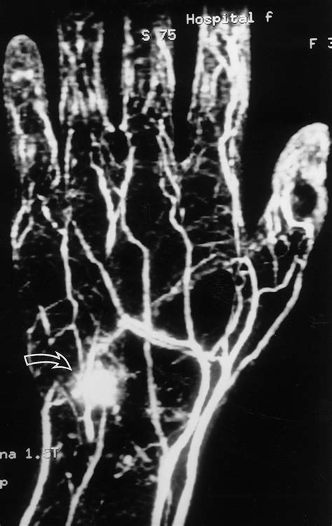 Contrast Enhanced Mr Angiography Of The Hand Radiographics