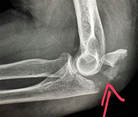 Elbow Xray Shows A Fracture Of The Ulna Olecranon In A Patient Who