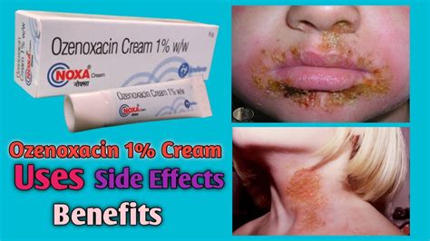 Noxa Cream Uses Ozenoxacin Cream Uses Side Effects Benefits