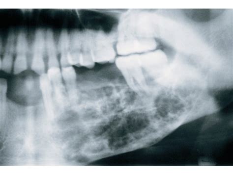 A Digital Manual For The Early Diagnosis Of Oral Neoplasia