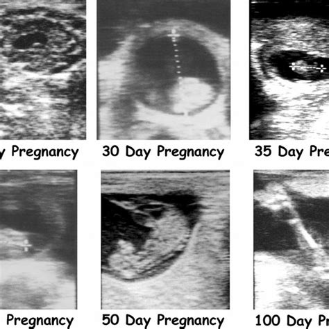 Ultrasound Images Of Embryo Or Fetal Development At Various Stages Of